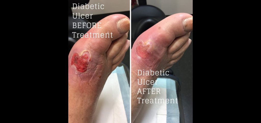 ulcer-before-1024x484-1 (1)